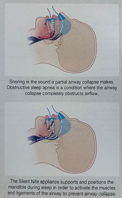 Snoring diagrams 2
